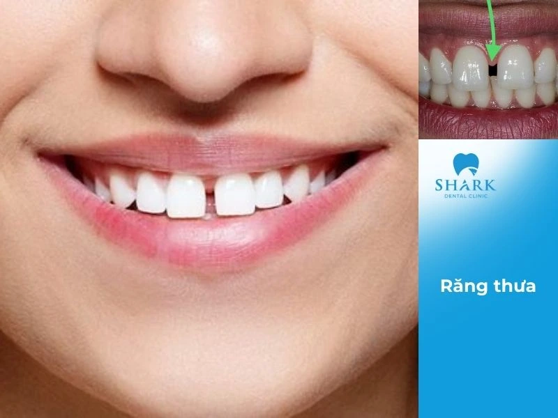 Răng thưa là dáng răng thiếu thẩm mỹ