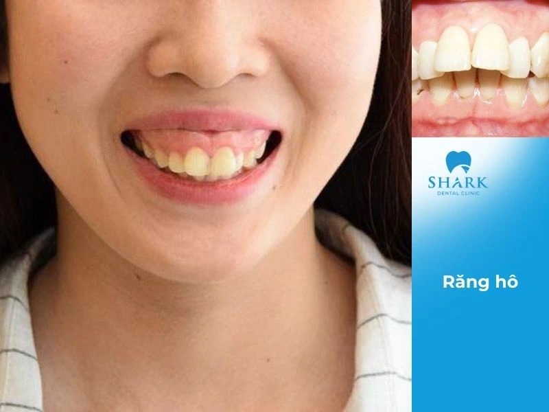Răng hô là tình trạng sai lệch khớp cắn thường gặp
