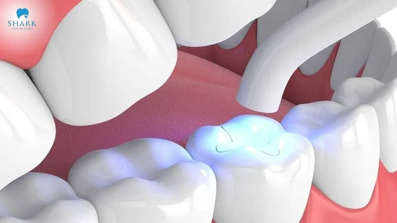 Top 5 vật liệu trám răng phổ biến hiện nay 10 Vật liệu Composite
