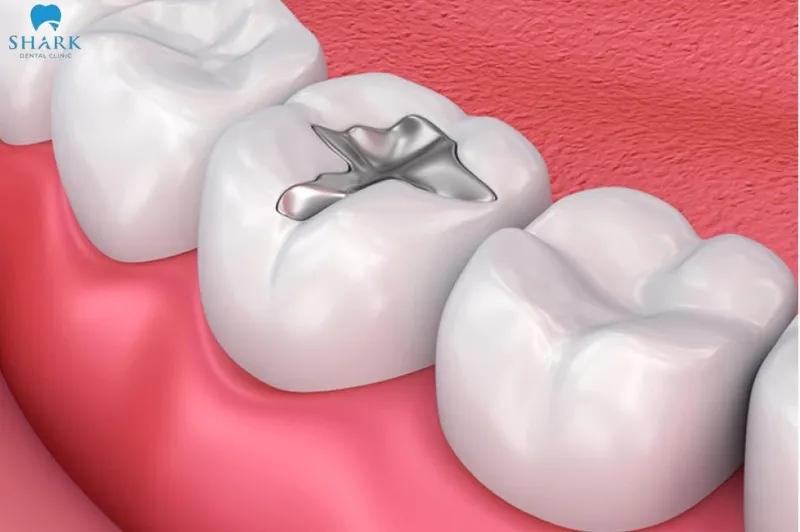 Top 5 vật liệu trám răng phổ biến hiện nay 11 Vật liệu trám răng Amalgam