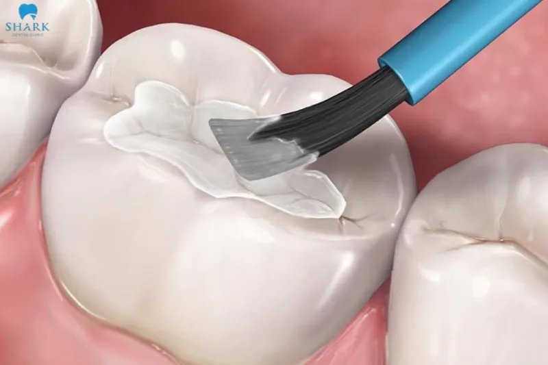 Top 5 vật liệu trám răng phổ biến hiện nay 12 Vật liệu GIC