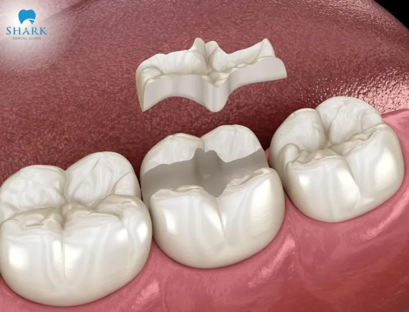 Top 5 vật liệu trám răng phổ biến hiện nay 13 Trám răng bằng vật liệu sứ