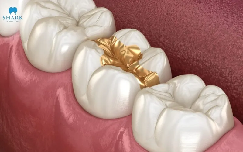 Top 5 vật liệu trám răng phổ biến hiện nay 14 Miếng trám bằng vàng