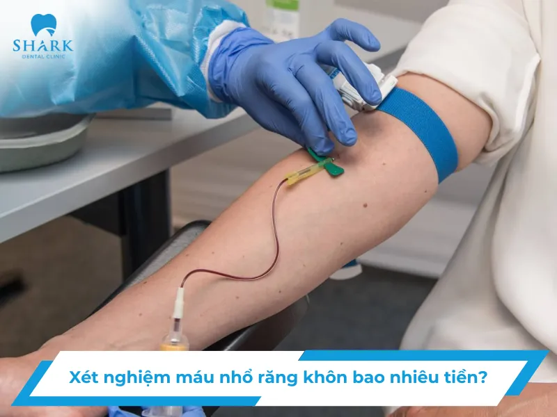 Xét nghiệm máu nhổ răng khôn bao nhiêu tiền?