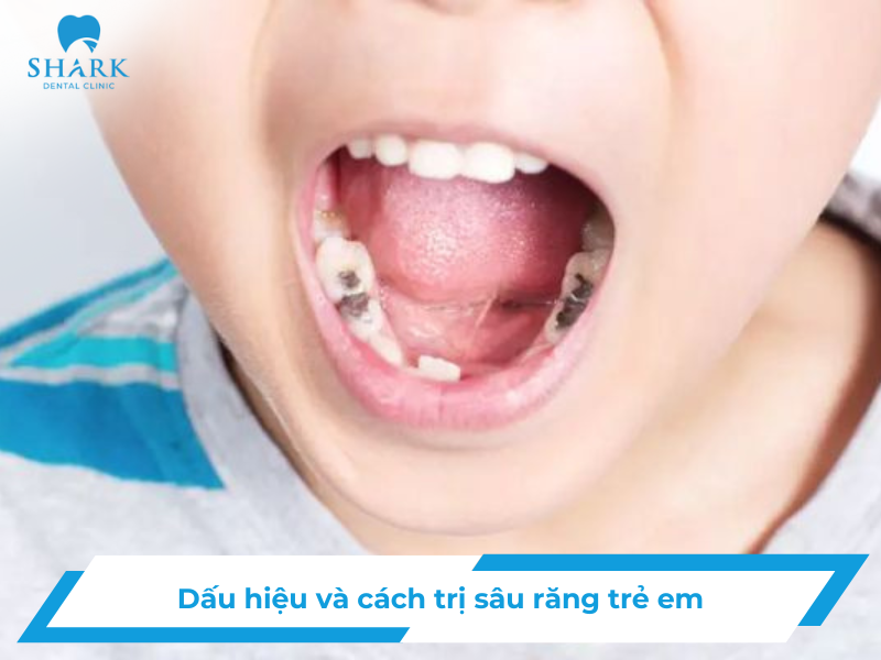 Sâu răng trẻ em