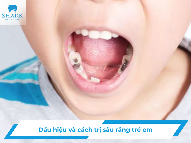 Sâu răng trẻ em