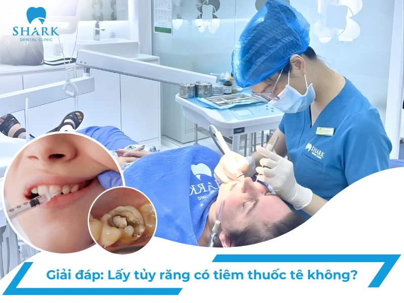 Giải đáp thắc mắc: Lấy tủy răng có tiêm thuốc tê không? 8 Lấy tủy răng có tiêm thuốc tê không