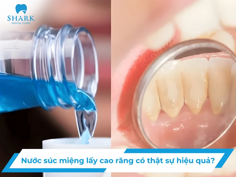 Giải đáp: Nước súc miệng lấy cao răng có hiệu quả không? 9 Nước súc miệng lấy cao răng có thật sự hiệu quả