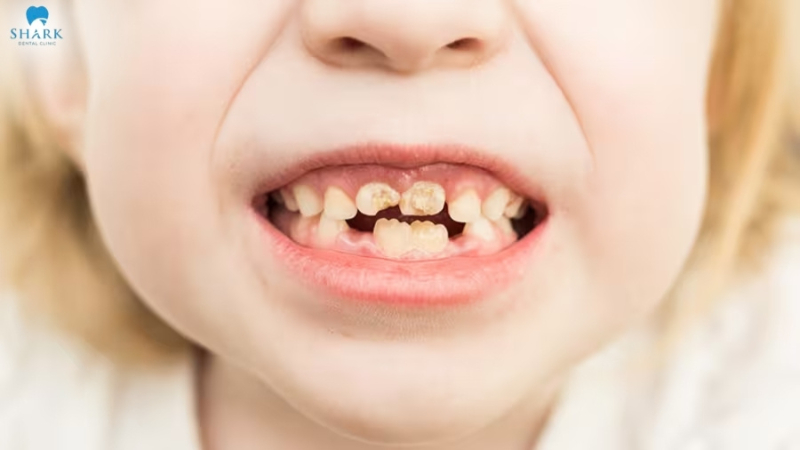 Sâu răng trẻ em: Dấu hiệu sâu răng và cách trị sâu răng trẻ em 11 Sâu răng sữa ở trẻ