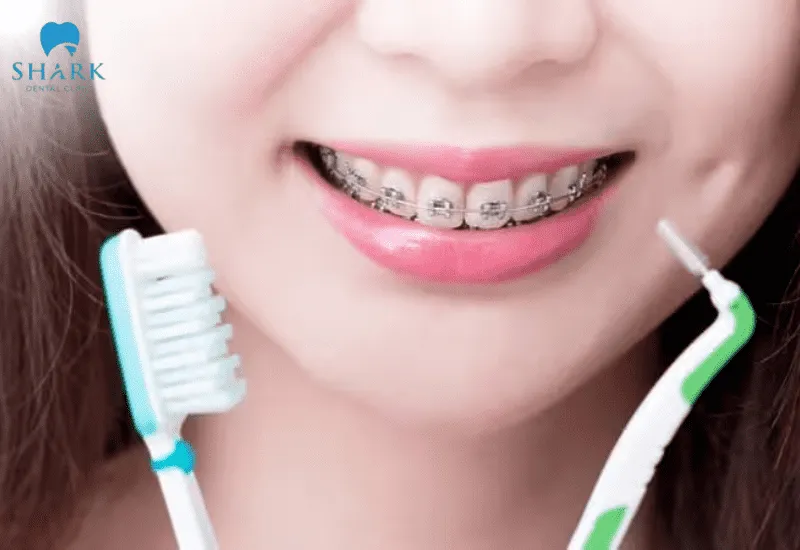 Top 5 loại bàn chải cho người niềng răng 9 Niềng răng gây khó khăn trong quá trình vệ sinh răng miệng