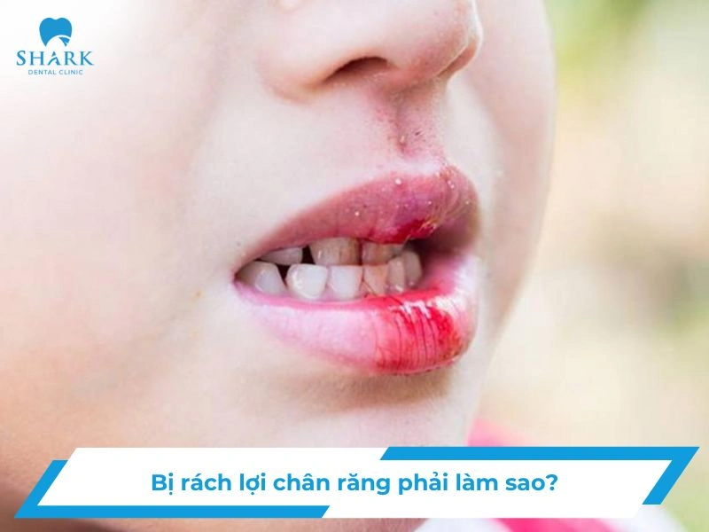Bị rách lợi chân răng phải làm sao