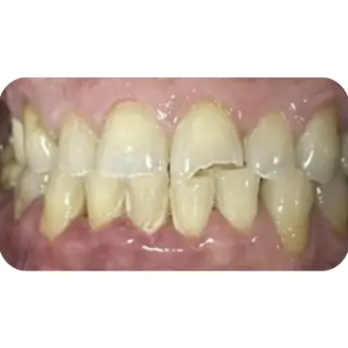 boc 28 rang su zirconia 2
