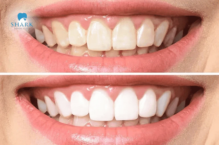 Giúp răng trắng sáng tự nhiên bằng cách sử dụng bột tẩy trắng răng