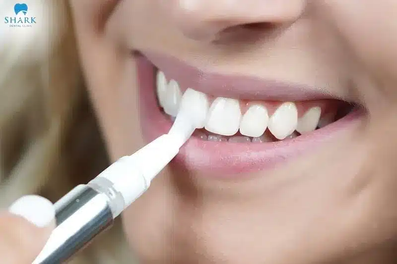 Biết cách sử dụng bút tẩy trắng răng sẽ giúp đạt được hiệu quả trắng răng tối ưu