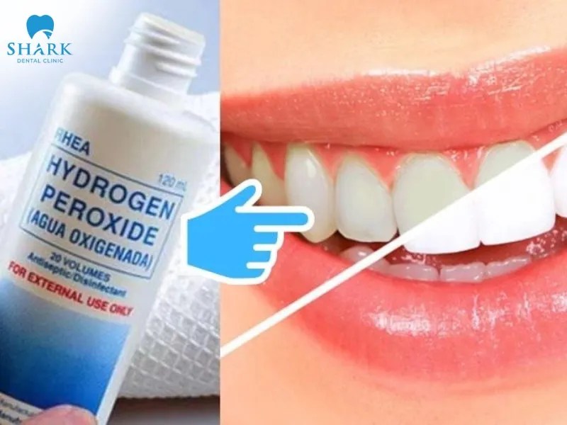 Cách làm trắng răng sau 1 đêm tại nhà an toàn, hiệu quả nhất 20 Oxy già có công dụng sát khuẩn giúp làm trắng răng hiệu quả