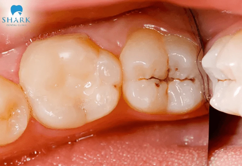 2 cách ngâm rượu cau chữa sâu răng hiệu quả và an toàn 9 Rượu cau ngâm không thể điều trị sâu răng dứt điểm