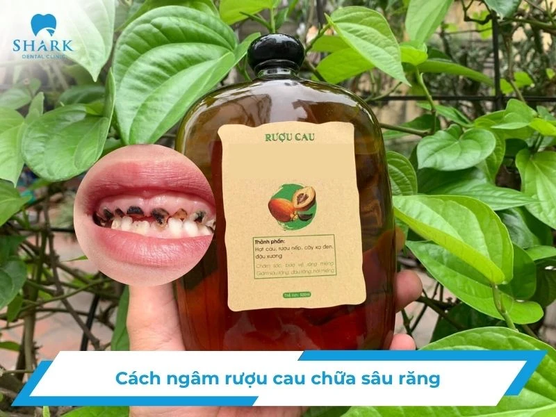 Cách ngâm rượu cau chữa sâu răng