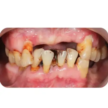 cay ghep implant all on 6 2