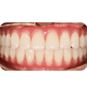 cay ghep implant all on 6 3