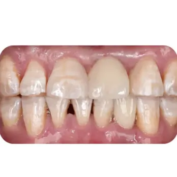 cay ghep implant don le 3