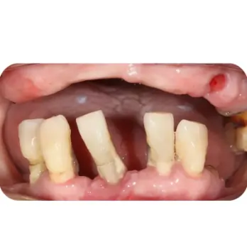 cay implant all on 6 2 1