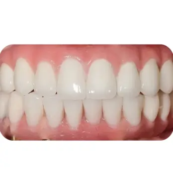 cay implant all on 6 3 1