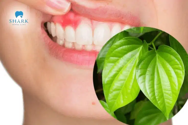Lá trầu không là bài thuốc dân gian được nhiều người sử dụng để chữa sâu răng