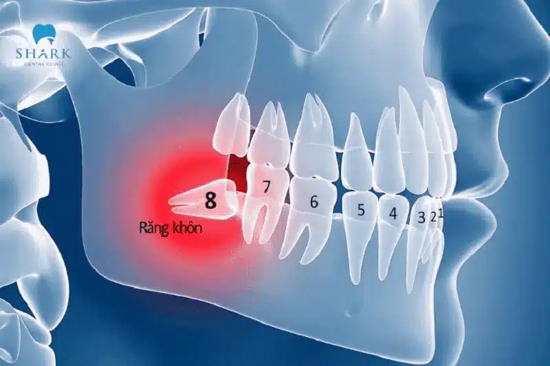 Có phải ai cũng mọc răng khôn không? Cần lưu ý gì? 5 Răng khôn thường mọc cuối cùng trên cung hàm