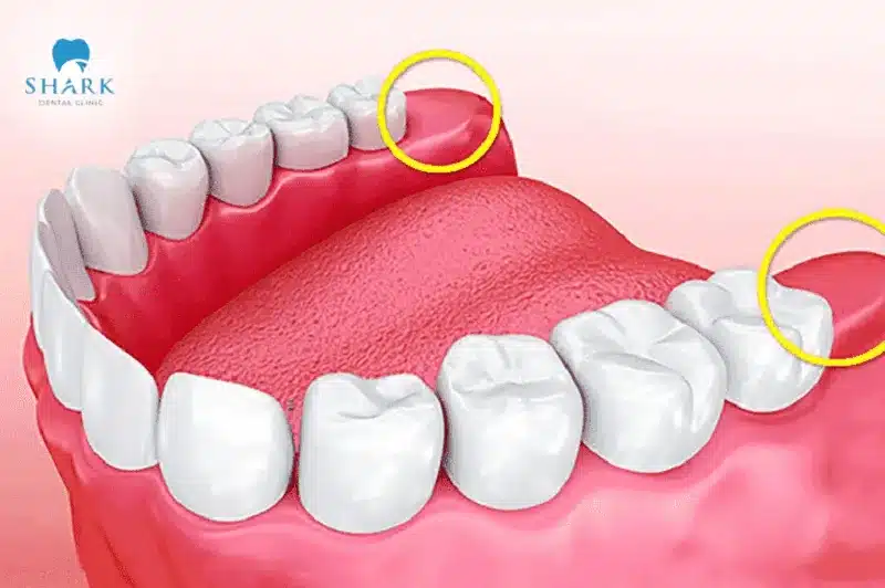 Có phải ai cũng mọc răng khôn không? Cần lưu ý gì? 6 Không mọc răng khôn không phải là tình trạng hiếm gặp