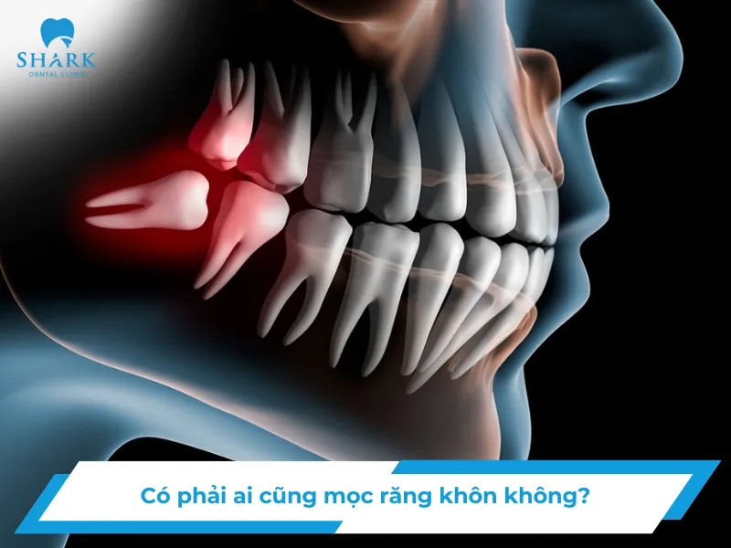 Có phải ai cũng mọc răng khôn không