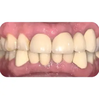 dan 24 rang su veneer emax 2