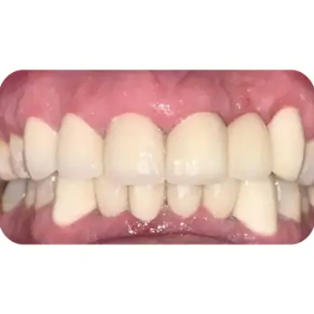 dan 24 rang su veneer emax 3