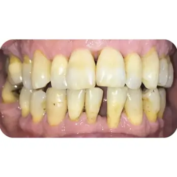 dan su veneer lava 2