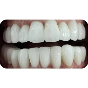 dan su veneer lava 3