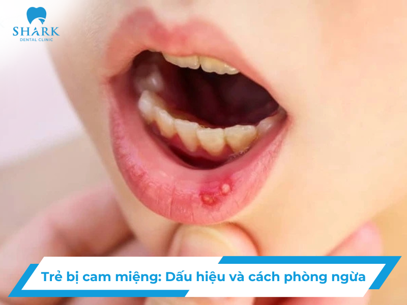 dấu hiệu trẻ bị cam