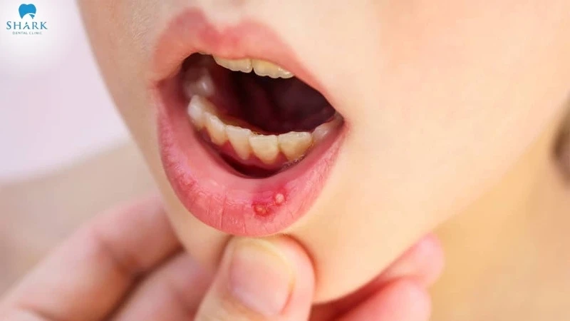 Trẻ bị cam miệng: Nguyên nhân, dấu hiệu và cách phòng ngừa 13 Dấu hiệu trẻ bị cam