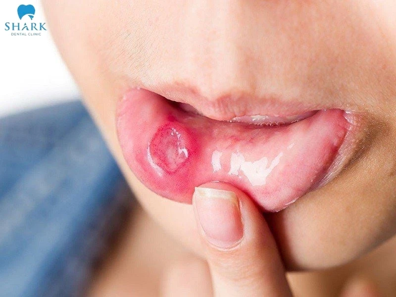 Trẻ bị cam miệng: Nguyên nhân, dấu hiệu và cách phòng ngừa 14 Hình ảnh bé bị cam miệng