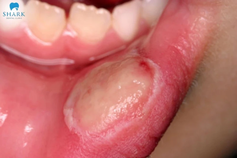 Trẻ bị cam miệng: Nguyên nhân, dấu hiệu và cách phòng ngừa 16 Hình ảnh bé bị cam miệng