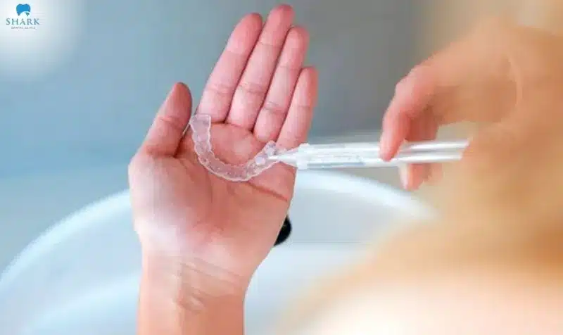 Gel làm trắng răng chỉ là giải pháp tạm thời, không thể thay thế hoàn toàn cho những liệu trình tẩy trắng chuyên sâu tại nha khoa