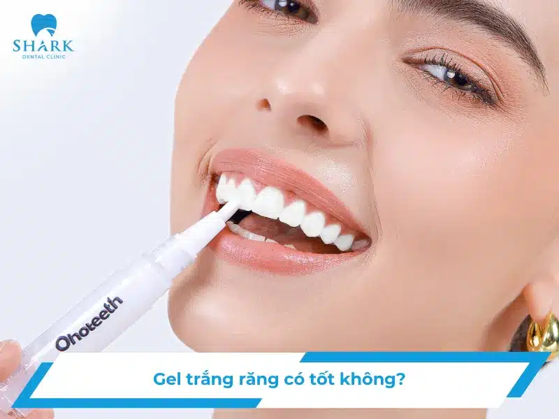 Gel trắng răng có tốt không