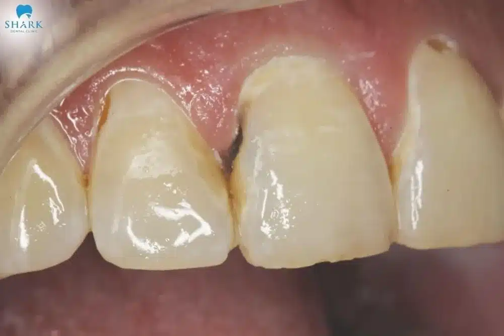 Hình ảnh con sâu răng tại các kẽ răng