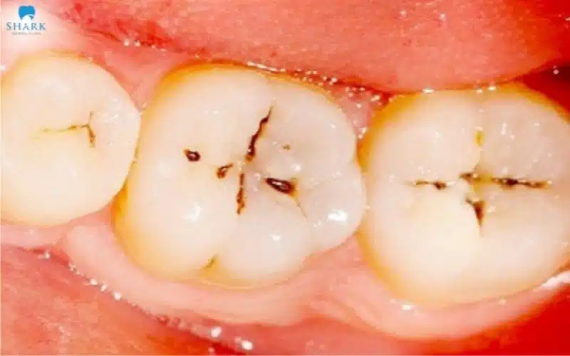 Biểu hiện sâu răng ở mức độ 1 là xuất hiện những đốm li ti trên bề mặt răng