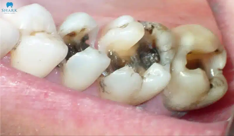 Sâu răng bán phần là tình trạng răng bị vi khuẩn phá hủy một nửa phần mô răng