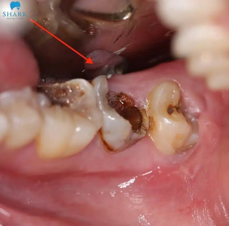 Hình ảnh sâu răng nặng, vi khuẩn đã phá hủy toàn bộ thân răng