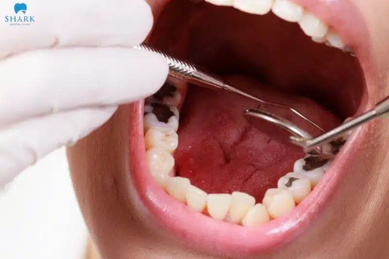 Hình ảnh minh họa sâu răng ở người trưởng thành