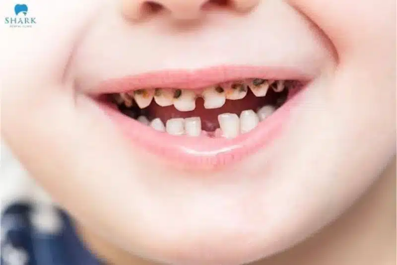 Hình ảnh sâu răng sữa thường thấy ở trẻ