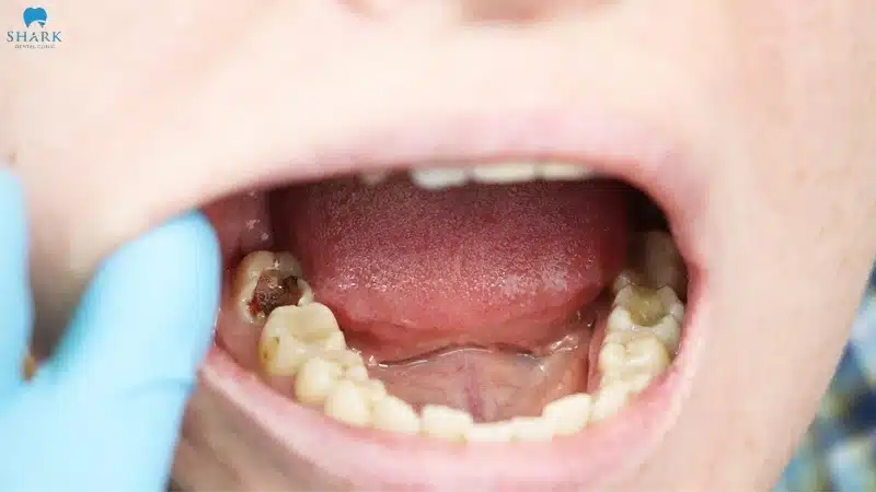 Sâu răng vĩnh viễn gây ảnh hưởng nghiêm trọng đến chức năng ăn nhai và thẩm mỹ của răng