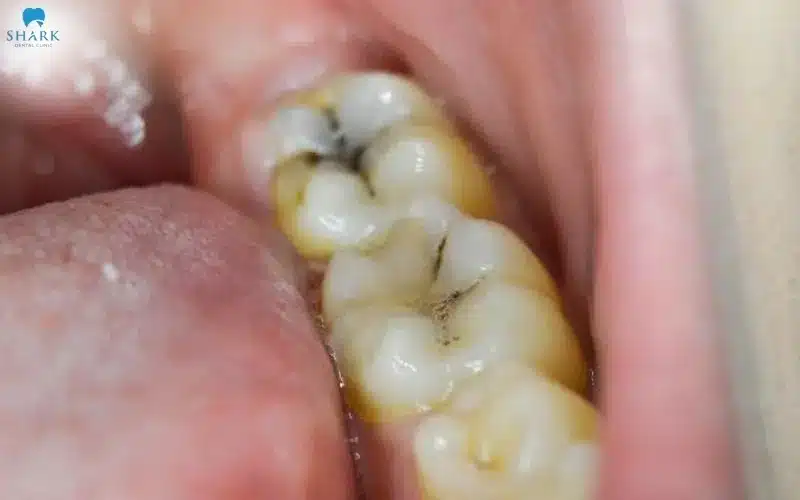 Hình ảnh răng sâu ở mức độ 2