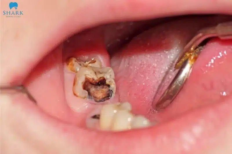 Qua hình ảnh răng sâu nặng, có thể thấy lúc này răng đã bị phá huỷ cấu trúc hoàn toàn