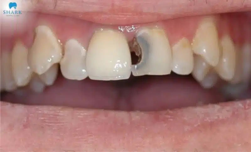 Hình ảnh con sâu răng phá huỷ phần răng cửa, gây mất thẩm mỹ nghiêm trọng